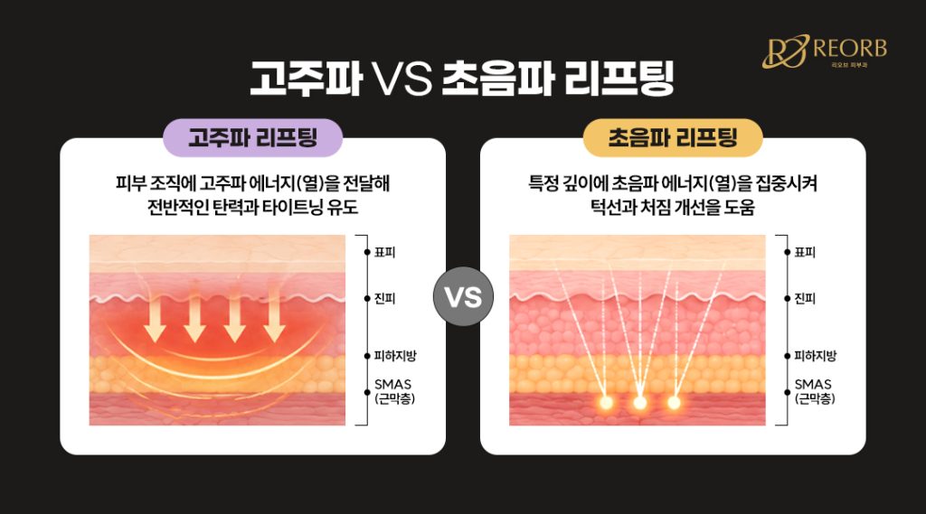 고주파 VS 초음파 리프팅