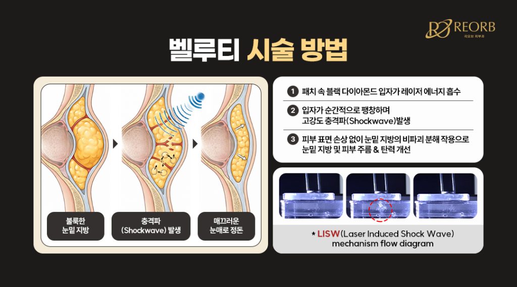 벨루티 아이 (Belluti Eye) 시술방법