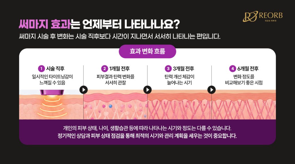써마지리프팅 효과는 언제 볼 수 있을까요?