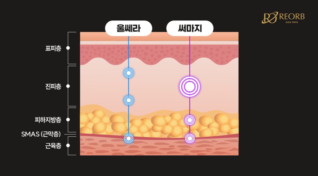 울쎄라 VS 써마지 어떻게 다를까요?