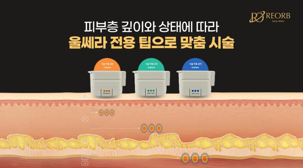 울쎄라 카트리지 : 1.5mm, 3.0mm, 4.5mm