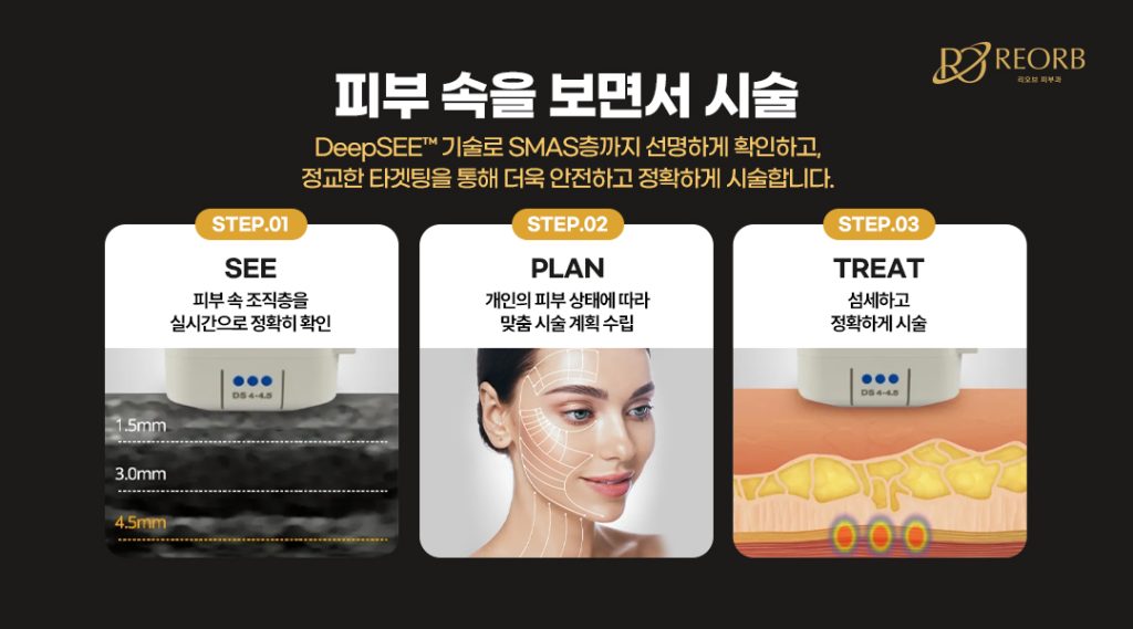 울쎄라 DeepSEE 기술이란?