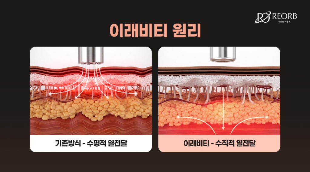 이래비티리프팅 원리