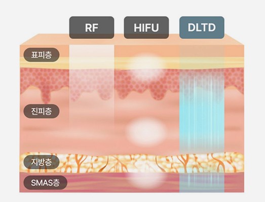 RF·HIFU·DLTD 에너지가 표피층·진피층·지방층·SMAS층에 전달되는 깊이를 비교한 피부층 모식도
