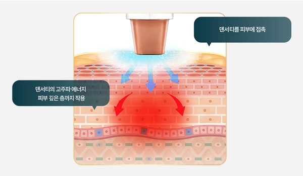 덴서티 고주파 에너지가 피부 깊은 층까지 작용하는 모식도