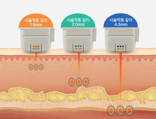 시술적용 깊이 1.5mm, 3.0mm, 4.5mm 팁별로 초음파 에너지가 도달하는 피부층 모식도